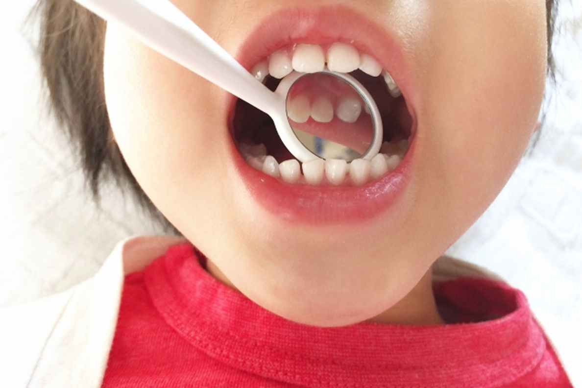 子どもの虫歯について